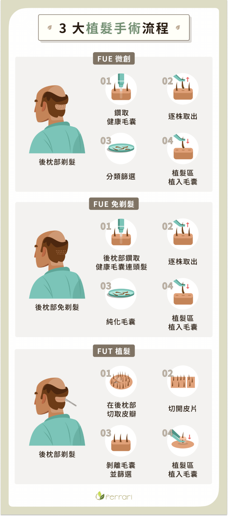  3 大植髮手術流程